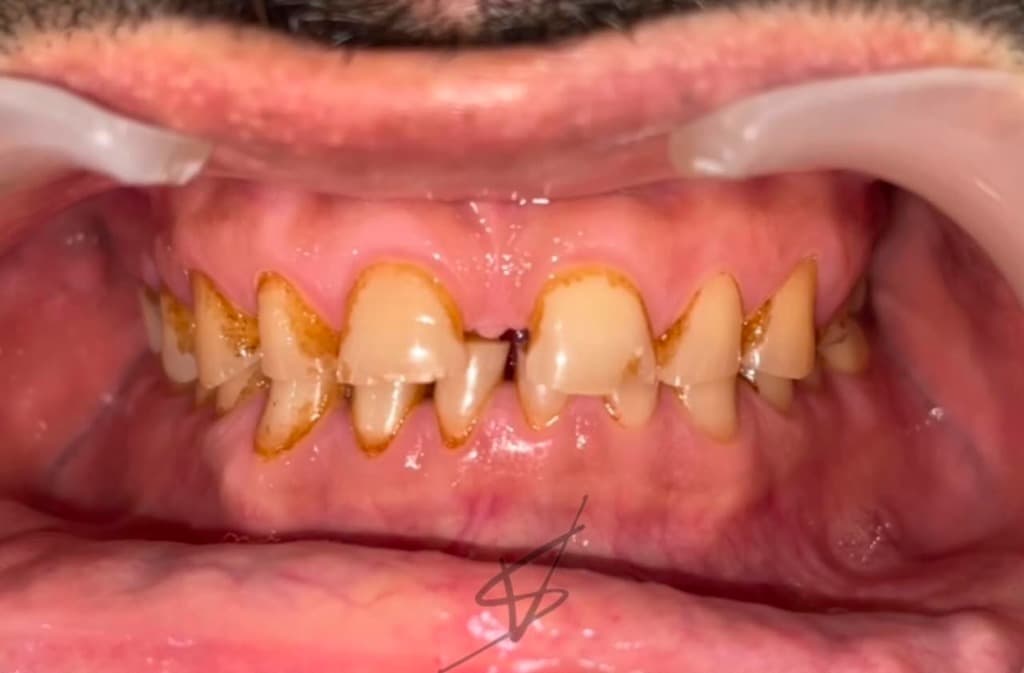 After dental treatment